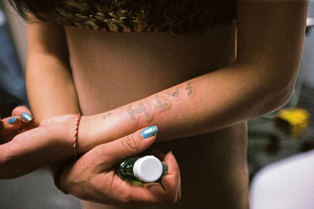 MIKAELA MACKENZIE / WINNIPEG FREE PRESS
Yazidi refugee Faeza Mejo holds her arm after her first laser removal session at Bionic Tattoo Removal in Winnipeg on Wednesday.