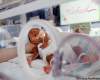 Yoav Levy
Premature infant affected by fetal alcohol syndrome in an incubator.