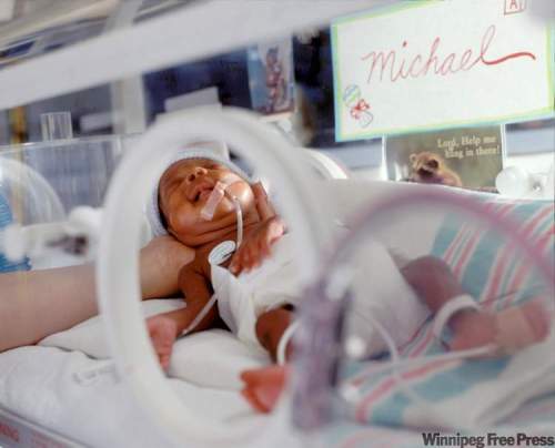 Yoav Levy
Premature infant affected by fetal alcohol syndrome in an incubator.