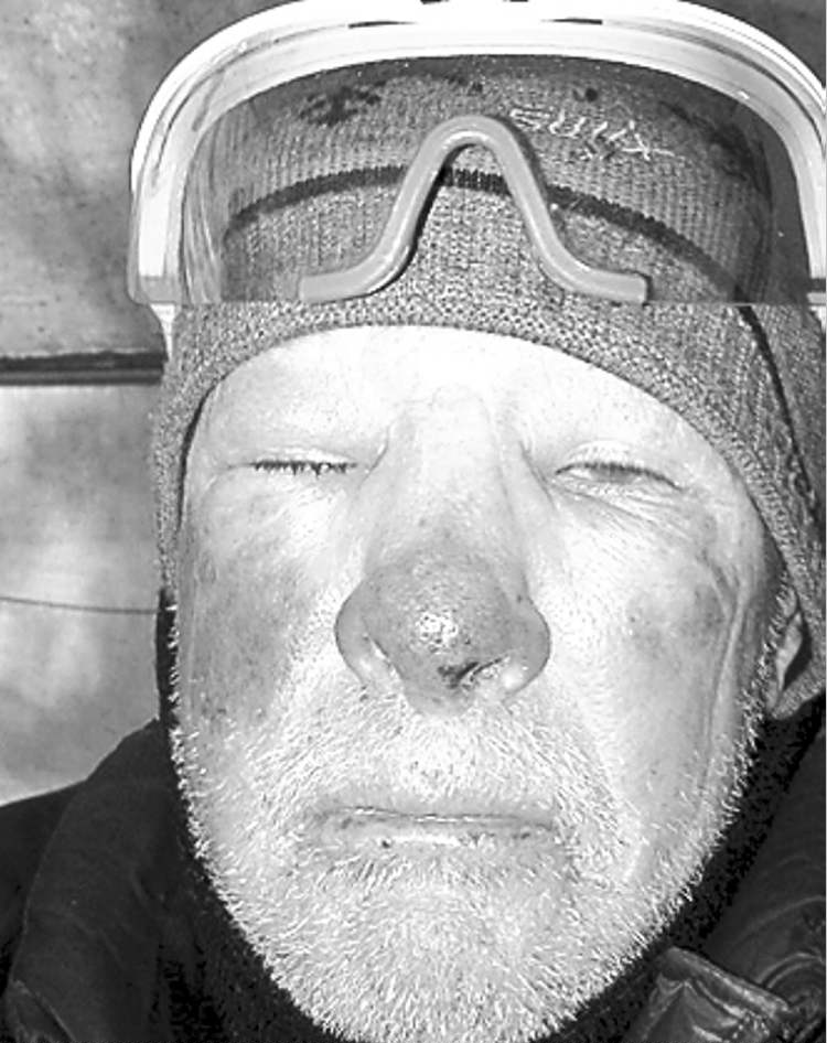 Lindsay Gauld with frostbite injuries while involved in the 2012 Itidarod Trail Invitational. Handout photo.