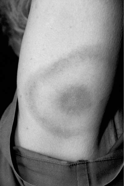 James Gathany / The Canadian Press archives
A patient exhibits the bull's-eye rash on the upper arm.