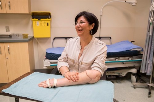 Maryam Zolfi, who had a successful arm transplant, poses for a picture showing her right hand resting on top of her transplanted arm, at Toronto Western Hospital, in Toronto, Monday June 20, 2016. THE CANADIAN PRESS/Mark Blinch