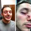 Twitter
Winnipeg Jets forward Marko Dano shows off his new stiches.