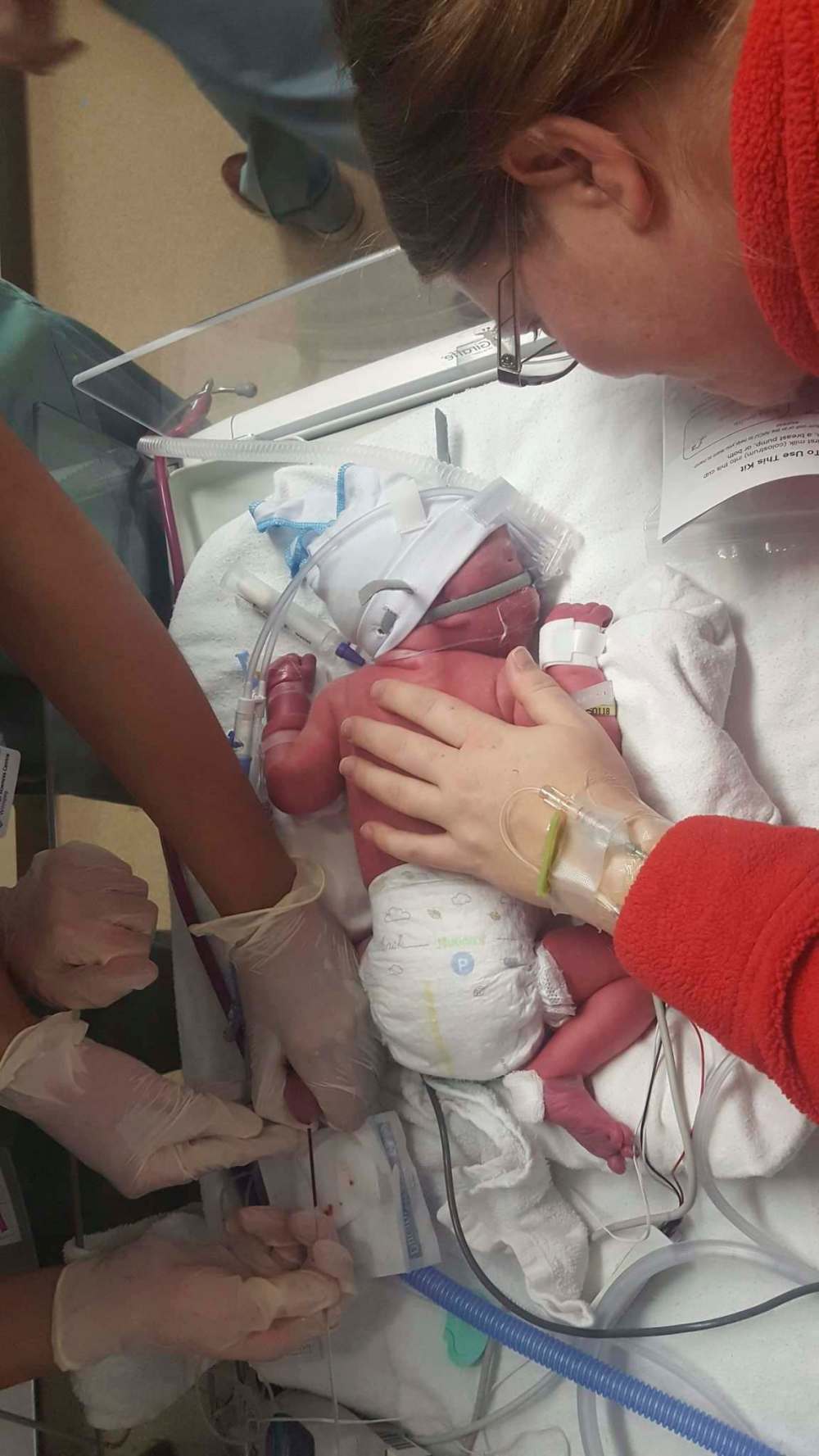 Ellie was born prematurely with a congenital heart defect and a congenital trachea defect; her stay in the neonatal intensive care unit (NICU) continues to this day. (Supplied)