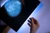 To lower mortality rates, the breast cancer screening rate should be 70 per cent of the population; colon cancer screening should be 60 per cent; and cervical cancer screening should be between 70 per cent and 80 per cent, the Canadian Cancer Society says. (Dreamstime/TNS Files)