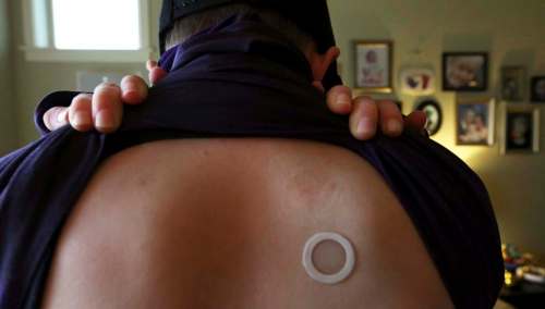 Alan Berner / Seattle Times
Spencer Baty, 11, has a skin patch applied to his back to help desensitize him to peanuts.
