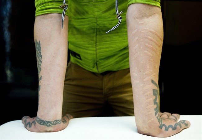 Blair McLean shows off his scarification which is 20 years-old and similar to tattooing but instead you burn your skin to create scar tissue as a work of art in Toronto on Thursday, Oct. 3, 2013. The procedure, known as scarification, is a form of extreme and permanent body modification that is offered in many tattoo and piercing stores across the country and is gaining popularity. THE CANADIAN PRESS/Nathan Denette