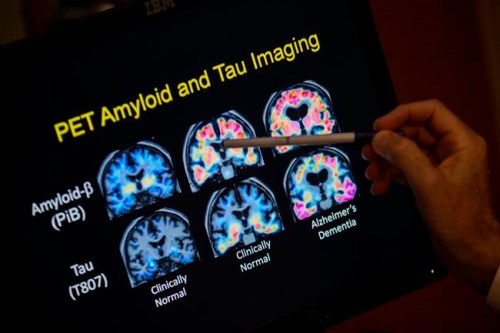 FILE - In this May 19, 2015, file photo, a doctor points to PET scan results that are part of a study on Alzheimer's disease at a hospital in Washington. Scientists know that long before the memory problems of Alzheimer's become obvious, people experience more subtle changes in their thinking and judgment. (AP Photo/Evan Vucci, File)