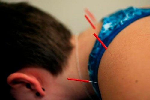 Acupuncture needles are applied on Sarah Taylor's back during an acupuncture treatment at the Children's National Medical Center in Washington, Monday, Dec. 10, 2018. Over and over, the 17-year-old struggled to make doctors understand her sometimes debilitating levels of pain, first from joint-damaging childhood arthritis and then from fibromyalgia. 