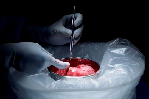 This image made from video provided by Johns Hopkins Medicine in Baltimore shows a kidney from Nina Martinez of Atlanta, who is thought to be the world‚Äôs first kidney transplant living donor with HIV, on Monday, March 25, 2019. Doctors transplanted one of her kidneys into an HIV-positive recipient who chose to remain anonymous. (Johns Hopkins Medicine via AP)