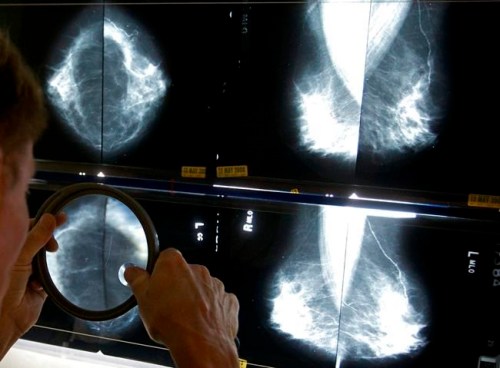 FILE - In this Thursday, May 6, 2010 file photo, a radiologist uses a magnifying glass to check mammograms for breast cancer in Los Angeles. Under a proposal released Wednesday, March 27, 2019, all U.S. women undergoing mammograms would receive extra information about breast density, which can sometimes make cancer harder to spot. (AP Photo/Damian Dovarganes, File)