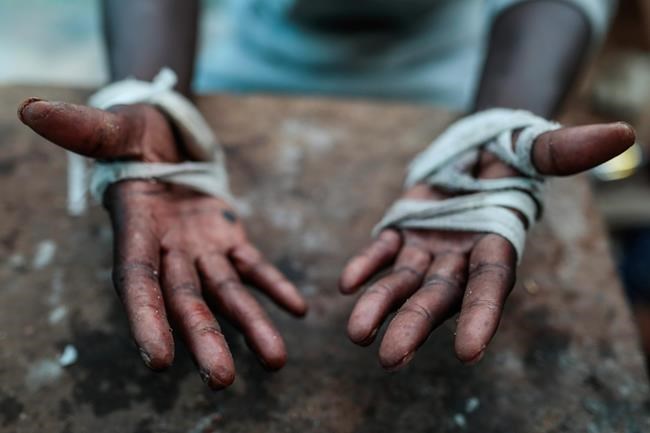 A sub-Saharan migrant shows injuries he sustained while trying to scale the Ceuta fence, at Ouled Ziane camp in Casablanca, Morocco, Thursday, Dec. 6, 2018. As Morocco prepares to host the signing of a landmark global migration agreement next week, hundreds of migrants are languishing in a Casablanca camp rife with hunger, misery and unsanitary conditions. These sub-Saharan Africans who dream of going to Europe are a symbol of the problems world dignitaries are trying to address with the U.N.'s first migration compact. (AP Photo/Mosa'ab Elshamy)