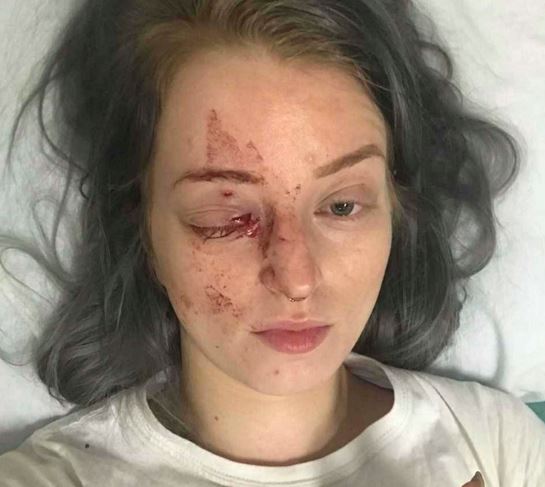 Brittney Thomas-Ljungberg is seen in her bed at the Misericordia Hospital after being punched in the eye by a random stranger. (Supplied)