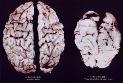 Photo courtesy of Dr. Sterling Clarren
A normal brain, left, and a brain severely affected by alcohol in the womb.