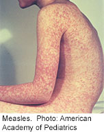 Symptoms of measles generally appear seven to 21 days after exposure. Initial symptoms may include fever, runny nose, drowsiness, irritability and red eyes. A few days after the initial symptoms, a red blotchy rash appears on the face and progresses down the body.