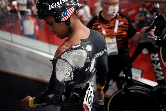 Muhammad Shah Firdaus Sahrom of Team Malaysia shows injuries after crashing in the track cycling men's keirin race at the 2020 Summer Olympics, Saturday, Aug. 7, 2021, in Izu, Japan. (AP Photo/Thibault Camus)