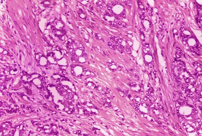 FILE - This 1974 microscope image made available by the Centers for Disease Control and Prevention shows changes in cells indicative of adenocarcinoma of the prostate. Some doctors say it’s time to rename low-grade prostate cancer to eliminate the alarming C word. About 34,000 Americans die from prostate cancer annually, but most prostate cancers are harmless. A paper published Monday, April 18, 2022 in the Journal of Clinical Oncology is reviving a debate about dropping the word “cancer” when patients learn the results of these low-risk biopsy findings. (Dr. Edwin P. Ewing, Jr./CDC via AP)