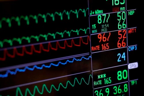 A screen displays a patient's vital signs during open heart surgery at the University of Maryland Medical Center in Baltimore on Nov. 28, 2016. Some experts fear that legislation intended to make it easier for intolerably suffering Canadians to receive medical assistance to end their lives might actually make it harder in some cases and will create confusion among doctors who provide the procedure.THE CANADIAN PRESS/AP, Patrick Semansky