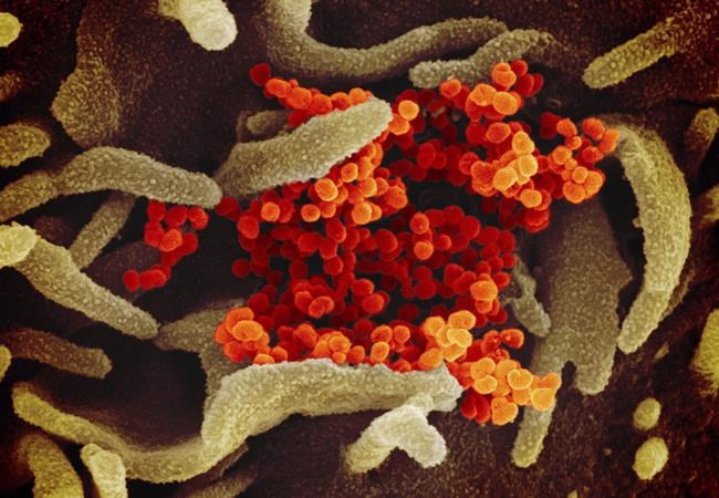 This undated electron microscope image made available by the U.S. National Institutes of Health in February 2020 shows the Novel Coronavirus SARS-CoV-2, orange, emerging from the surface of cells, green, cultured in the lab. Also known as 2019-nCoV, the virus causes COVID-19. The sample was isolated from a patient in the U.S. THE CANADIAN PRESS/AP-NIAID-RML via AP