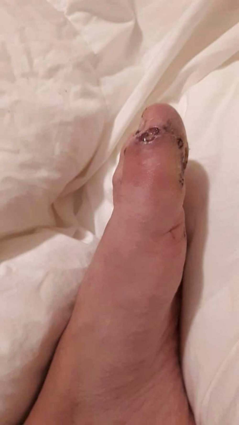 SUPPLIED
Flett went to St. Boniface Hospital emergency for a diabetic foot ulcer last Thursday.