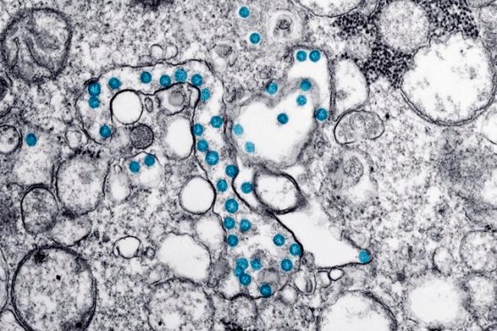 This 2020 electron microscope image made available by the U.S. Centers for Disease Control and Prevention shows the spherical particles of the new coronavirus, colorized blue, from the first U.S. case of COVID-19. Public health officials in New Brunswick say another person has died as a result of COVID-19 — the second death in the province linked to the pandemic. THE CANADIAN PRESS/AP-Hannah A. Bullock, Azaibi Tamin/CDC via AP, File