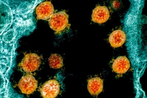 This electron microscope image made available and color-enhanced by the National Institute of Allergy and Infectious Diseases Integrated Research Facility in Fort Detrick, Md., shows Novel Coronavirus SARS-CoV-2 virus particles, orange, isolated from a patient. THE CANADIAN PRESS/AP-NIAID/National Institutes of Health via AP