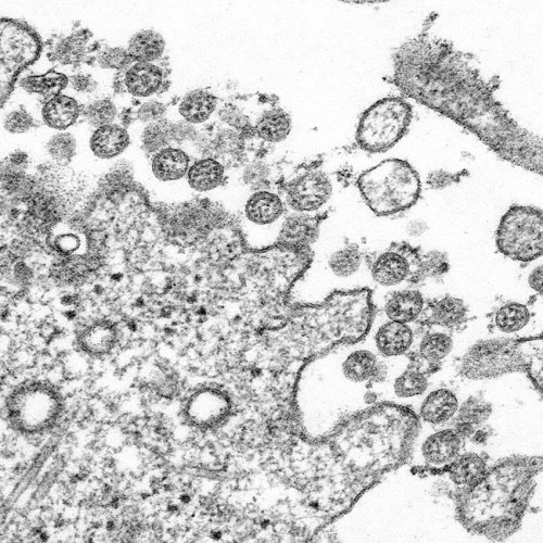 This 2020 electron microscope made available by the U.S. Centers for Disease Control and Prevention image shows the spherical coronavirus particles from the first U.S. case of COVID-19. THE CANADIAN PRESS/AP-C.S. Goldsmith, A. Tamin/ CDC via AP