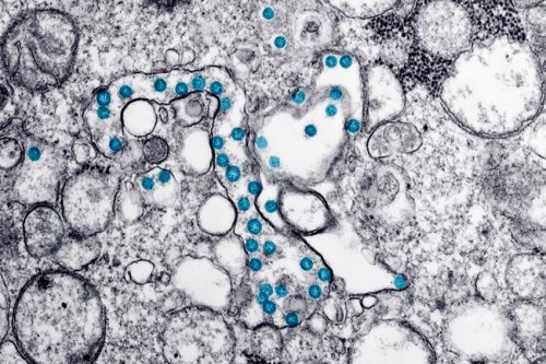This 2020 electron microscope image made available by the U.S. Centers for Disease Control and Prevention shows the spherical particles of the new coronavirus, colorized blue, from the first U.S. case of COVID-19. Researchers in Canada say the best early-warning system for a second wave of COVID-19 may be right beneath our feet, in the sewers. THE CANADIAN PRESS/AP-Hannah A. Bullock, Azaibi Tamin/CDC via AP)