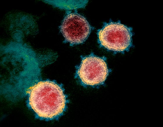 CPThis undated electron microscope image made available by the U.S. National Institutes of Health in February 2020 shows the virus that causes COVID-19. The sample was isolated from a patient in the U.S. (NIAID-RML via AP)
