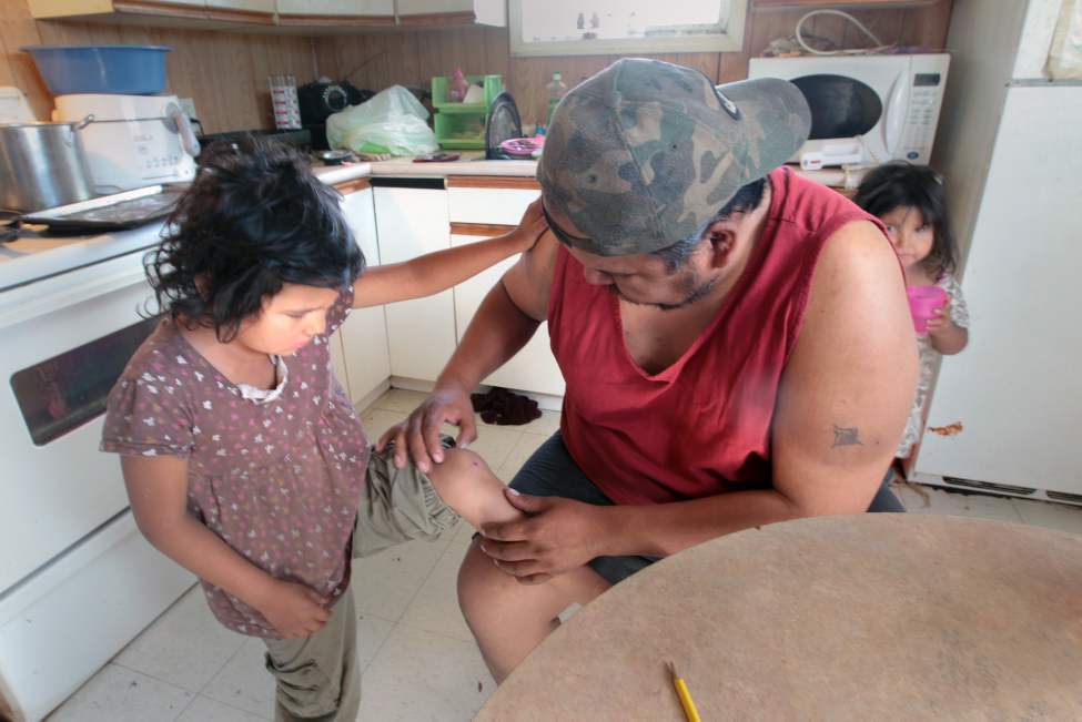 JOE.BRYKSA@FREEPRESS.MB.CA
Robert Little checks his daughter Dayna's knee for boils. Families without enough water are vulnerable to antibiotic-resistant superbugs like MRSA that cause boils and sometimes life-threatening infections.