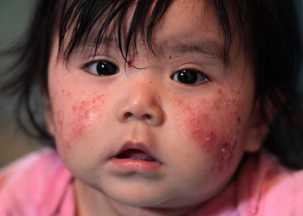 JOE BRYKSA/WINNIPEG FREE PRESS
NO RUNNING WATER FEATURE
- Lyra Harper with skin rash at Red Sucker Lake First Nation.
Homes with no running water make it difficult to keep children clean. July 2010
