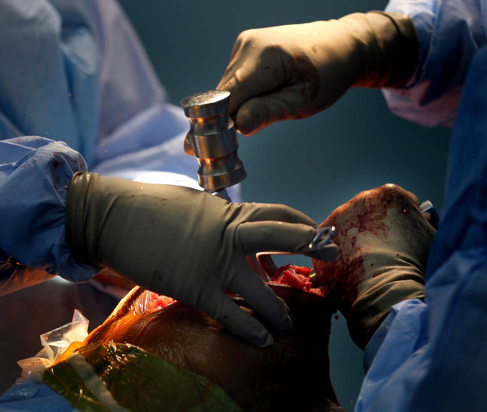 A stainless steel mallet drives home a piece of a knee replacement.