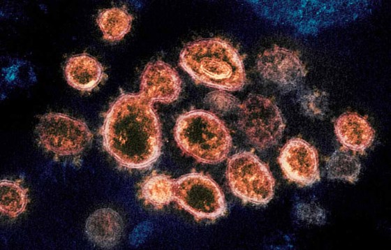 An electron microscope image provided by the National Institute of Allergy and Infectious Diseases in the U.S. shows the SARS-CoV-2 virus particles that cause COVID-19. (The Associated Press files)