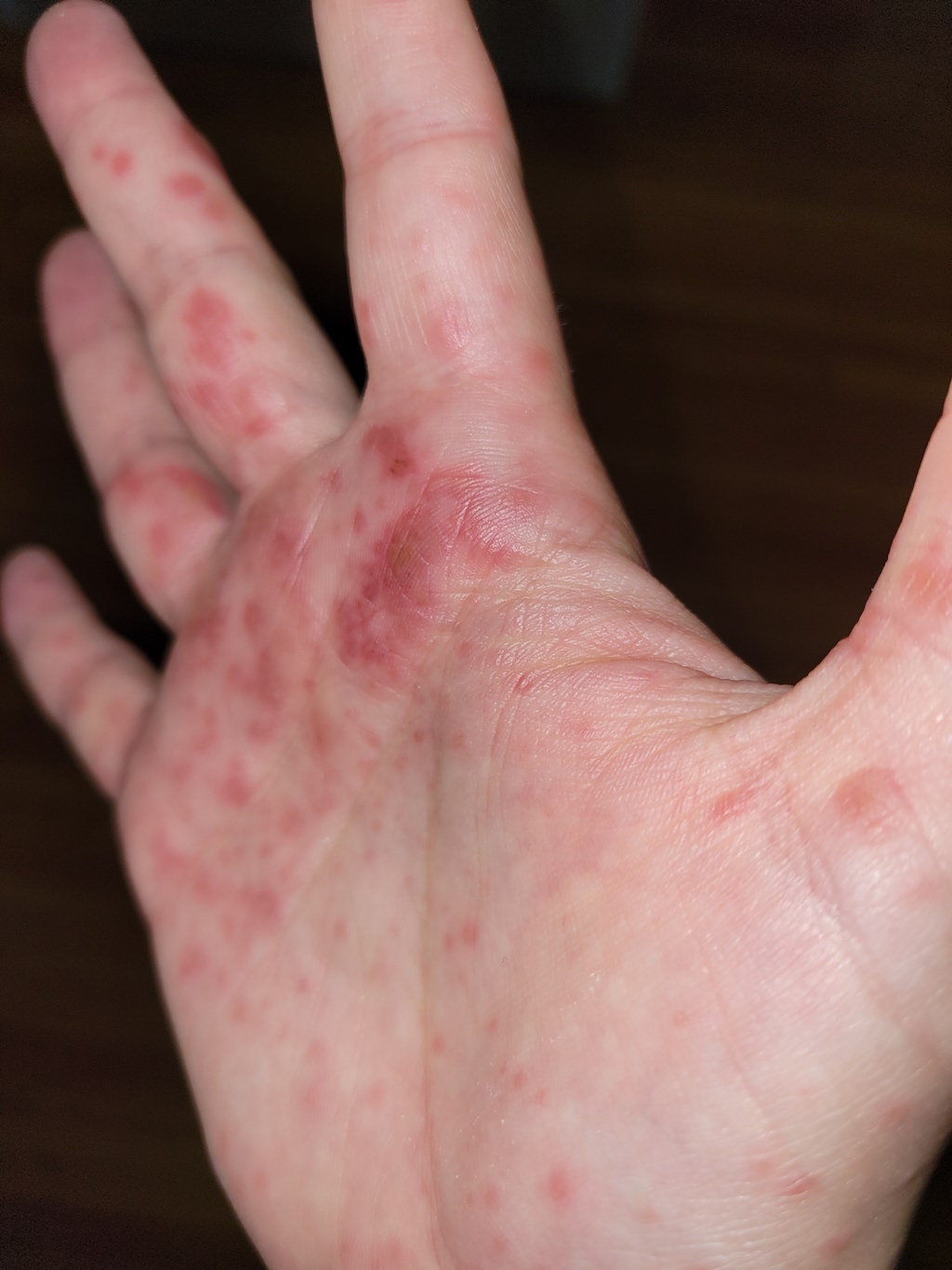 Hand, foot, and mouth disease strikes city daycare Winnipeg Free Press