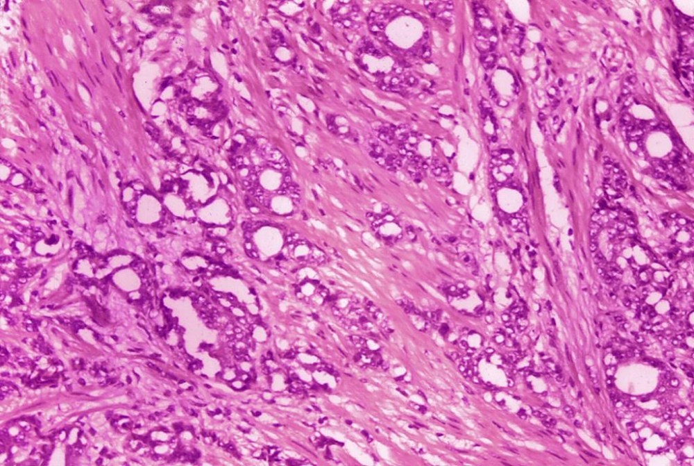 FILE - This 1974 microscope image made available by the Centers for Disease Control and Prevention shows changes in cells indicative of adenocarcinoma of the prostate. A study published by the New England Journal of Medicine on Saturday, March 11, 2023, finds long-term evidence that actively monitoring prostate cancer can be a safe alternative to immediate surgery or radiation. (Dr. Edwin P. Ewing, Jr./CDC via AP)
