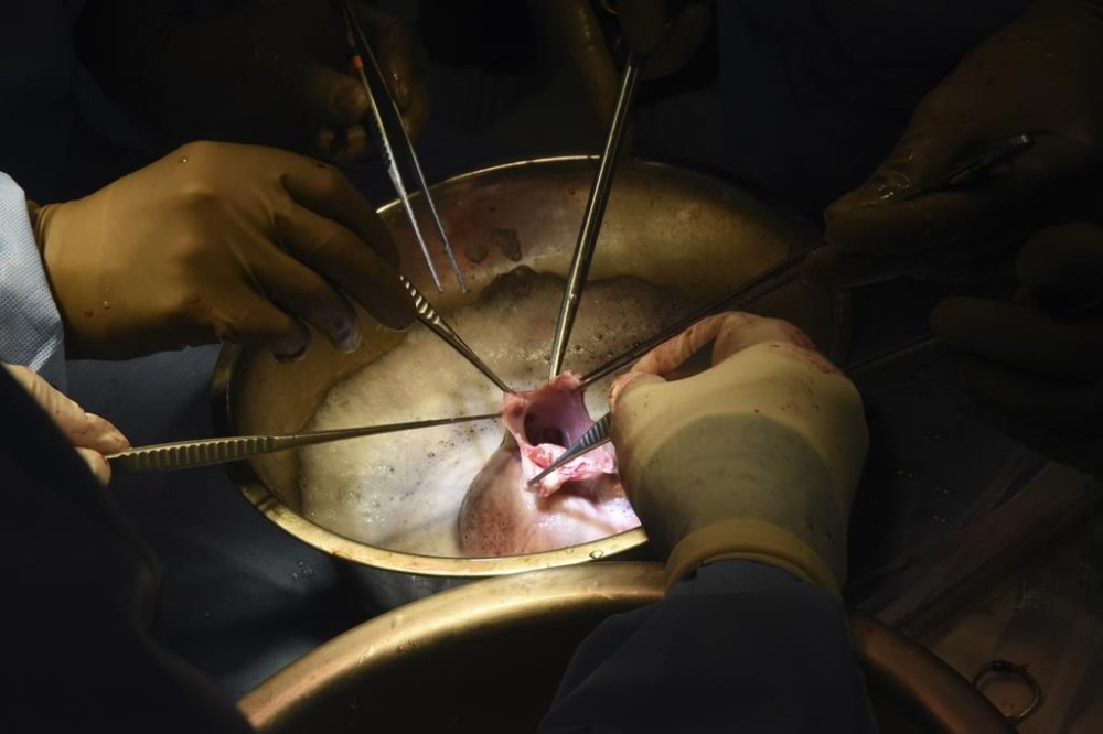 In this photo provided by the University of Maryland School of Medicine, surgeons perform a pig heart transplant into Lawrence Faucette at the school's hospital in Baltimore, Md., in September 2023. Two days after the transplant, Lawrence was cracking jokes and able to sit in a chair, doctors said Friday, Sept. 22, 2023. (Deborah Kotz/University of Maryland School of Medicine via AP)