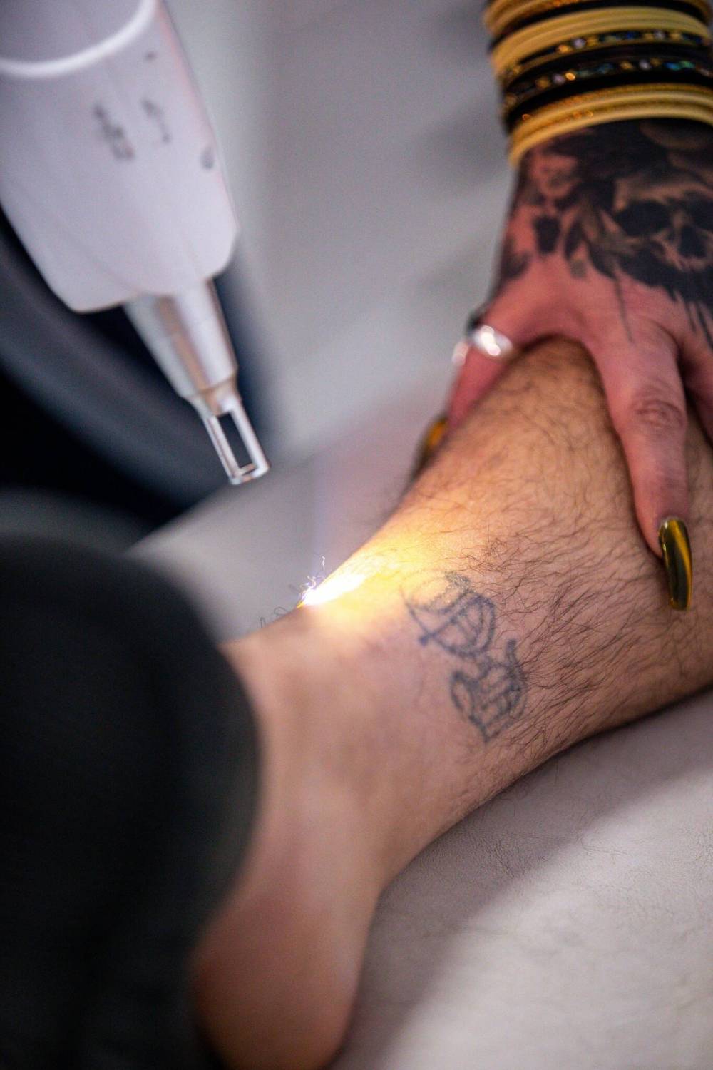 MIKAELA MACKENZIE / WINNIPEG FREE PRESS FILES
Steinke offers free tattoo removal to ex-gang members using a laser in the removal process.