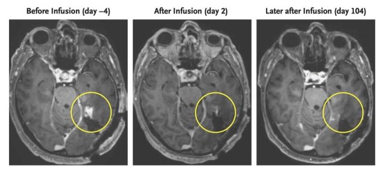 This combination of MRI scan images shows the progress of a glioblastoma patient who received CAR-T therapy. (New England Journal of Medicine)