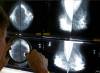 A radiologist uses a magnifying glass to check mammograms for breast cancer. (Damian Dovarganes / The Associated Press files)