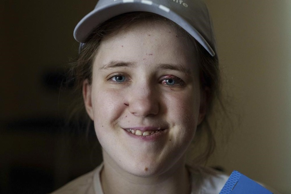 Solomiia, 16, poses for a photo a day after surviving a Russian missile strike on the Okhmatdyt children's hospital, in Kyiv, Ukraine, Tuesday, July 9, 2024. The toll of Russia’s heaviest bombardment of Kyiv in almost four months — one of the deadliest of the war — shows the devastating human cost of Russia’s improved targeting tactics. (AP Photo/Evgeniy Maloletka)