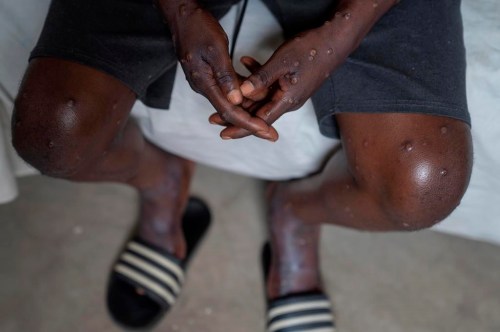 FILE - An unidentified man infected with mpox at the Goma General Hospital, Democratic Republic of Congo, on July 16, 2024 The type of mpox spreading rapidly through several African countries could arrive in Canada, where that strain hasn't appeared before, Canadian experts say. (AP Photo/Moses Sawasawa)