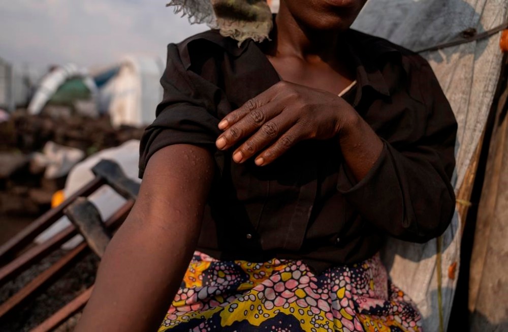 Sarah Bagheni, in the Bulengo refugee camp in Goma, Congo, suspects she may be infected with Mpox after the World Health Organization had declared Thursday, Aug, 15, 2024, the increasing spread of mpox in Africa a global health emergency, warning the virus might ultimately spill across international borders. (AP Photo/Moses Sawasawa)