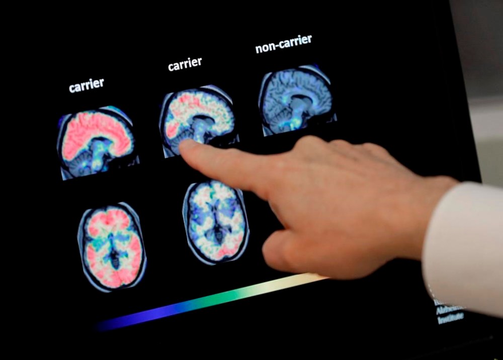 Dr. William Burke goes over a PET brain scan at Banner Alzheimer's Institute in Phoenix, Aug. 14, 2018. THE CANADIAN PRESS/AP-Matt York