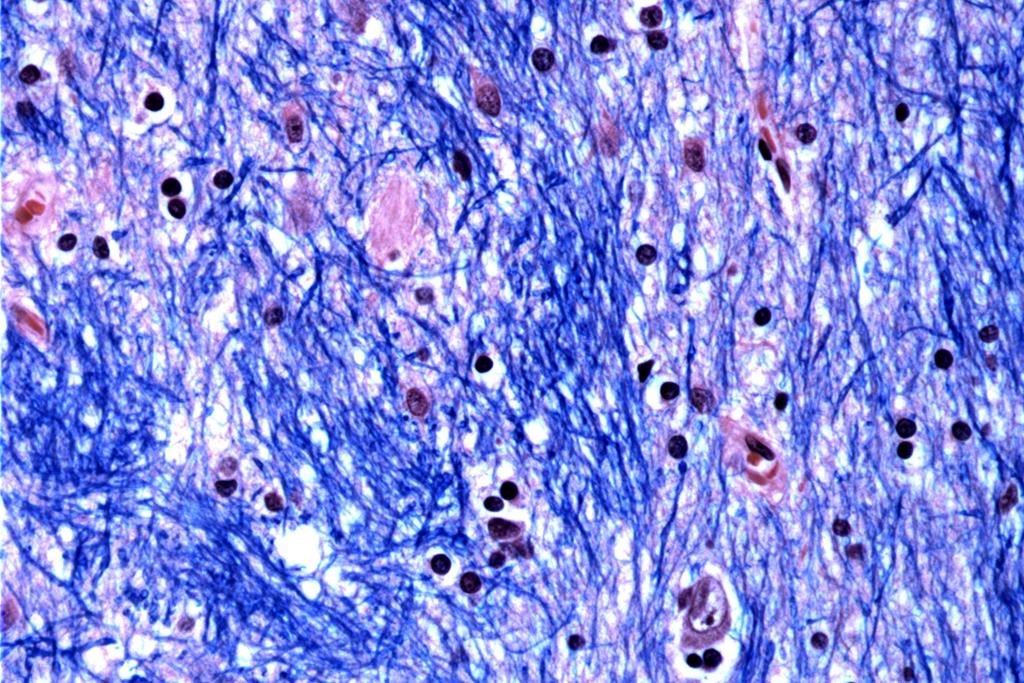 Researcher with Huntington's gene joins $400 million brain disease initiative