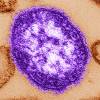 CDC / ASSOCIATED PRESS FILES
                                An electron microscope image of a measles virus particle.