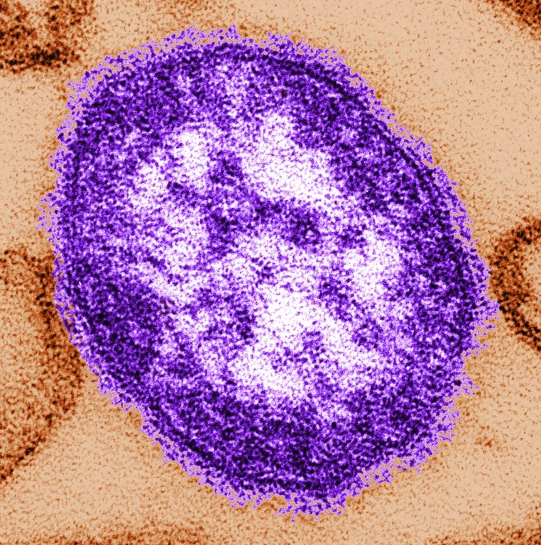 Ontario is seeing a massive surge in measles cases as an ongoing outbreak spreads in the province among unvaccinated people. This undated image made available by the Centers for Disease Control and Prevention on Feb. 4, 2015 shows an electron microscope image of a measles virus particle. THE CANADIAN PRESS/AP, HO — Centers for Disease Control and Prevention, Cynthia Goldsmith
