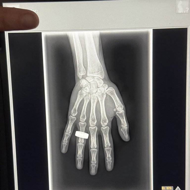 An x-ray of a hand taken at an unknown date. This is the first X-ray to be taken in space by KA Imaging of Waterloo, Ont. Four space tourists orbited the north and south poles earlier this month, a group of Canadians celebrated an X-ray image taken aboard the spacecraft using technology developed at the University of Waterloo.THE CANADIAN PRESS/HO KA Imaging **MANDATORY CREDIT**