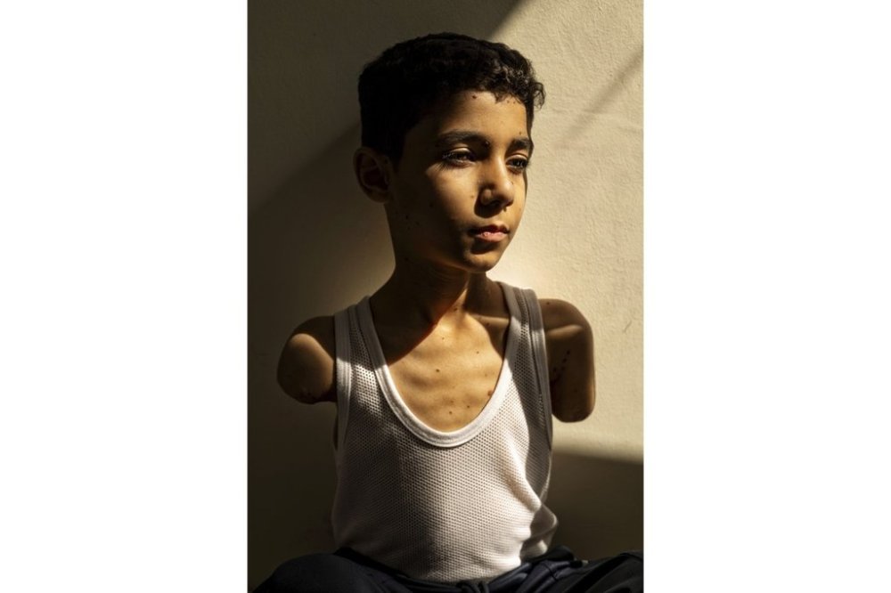 This image provided by World Press Photo and taken by Samar Abu Elouf, for The New York Times, won the World Press Photo Award of the Year and shows Mahmoud Ajjour (9), who was injured during an Israeli attack on Gaza City in March 2024, finds refuge and medical help in Doha, Qatar, 28 June 2024. (Samar Abu Elouf, for The New York Times/World Press Photo via AP)