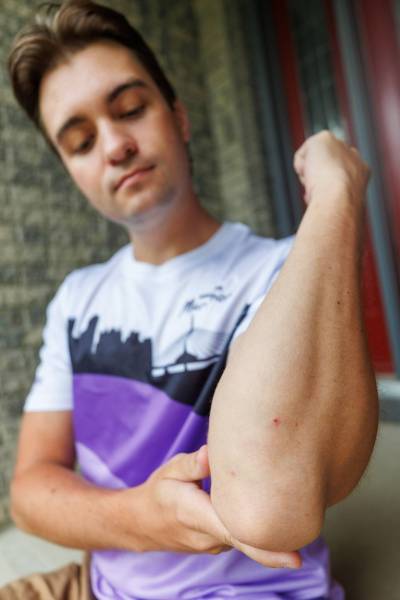 MIKE DEAL / FREE PRESS
                                Brendan Scott, a 28-year-old University of Manitoba dental student, has some bruising on his arm and a small cut, after a dog bit him while he was running the half marathon on Sunday.