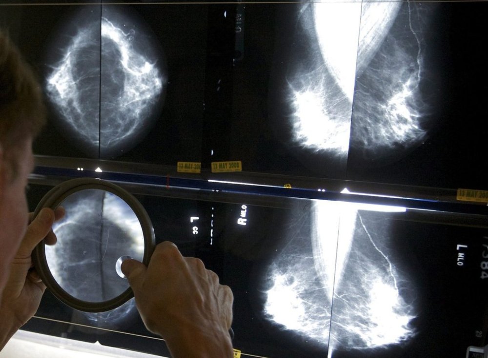 A radiologist uses a magnifying glass to check mammograms for breast cancer on May 6, 2010. THE CANADIAN PRESS/AP-Damian Dovarganes